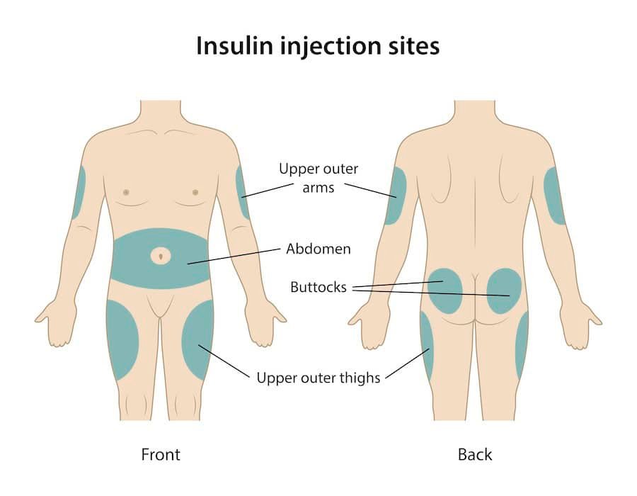 Subcutaneous Injection Sites Diagram